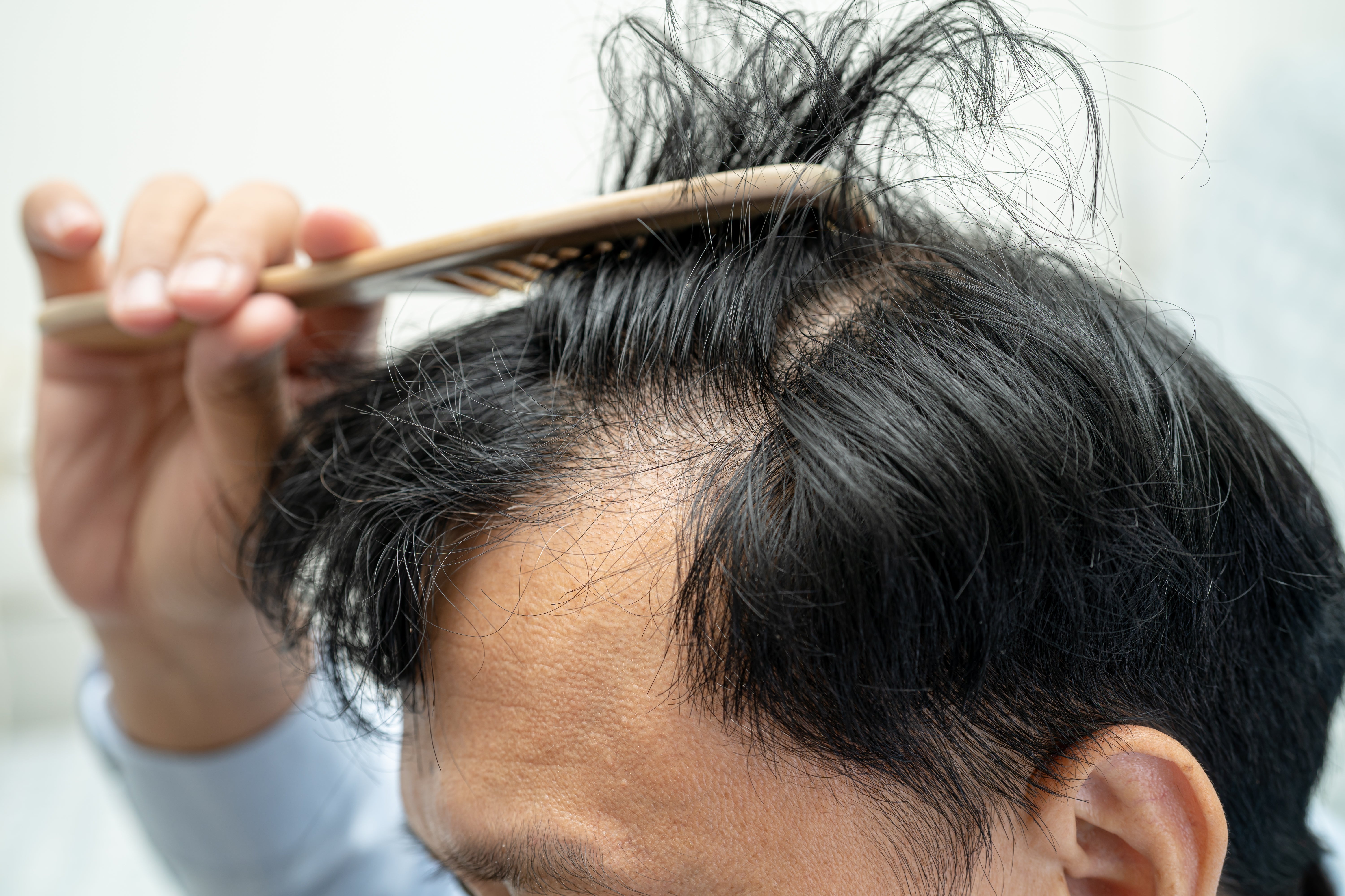 Can a Gummy Save Your Hairline? The Truth About Biotin & Hair Growth
